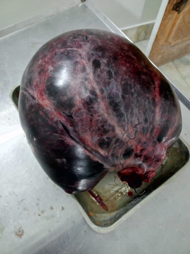 Medical team performing tumor surgery in Timergara