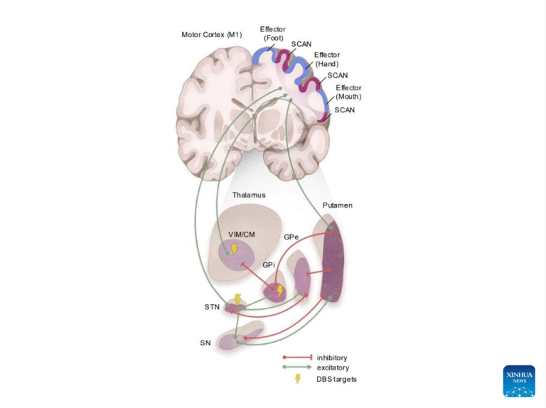 Chinese scientists identify core brain network linked to Parkinson’s disease Researchers illustrate the brain network identified by Chinese scientists as central to Parkinson’s disease.