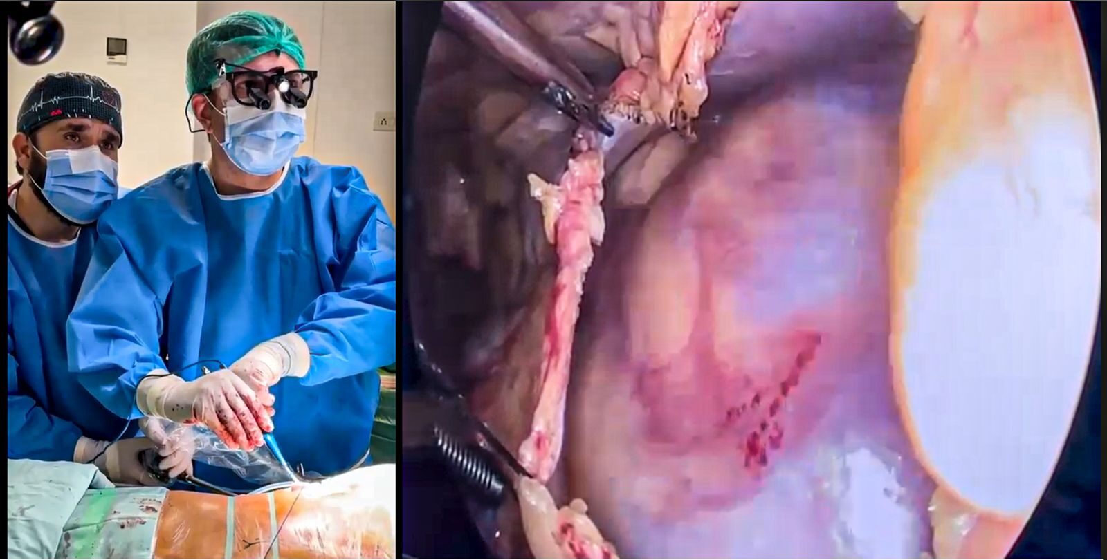 PIC performs Pakistan’s first successful endoscopic heart surgery