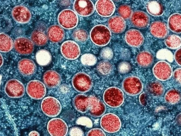 Karachi Reports Another Mpox Case, Taking City’s Total to Nine