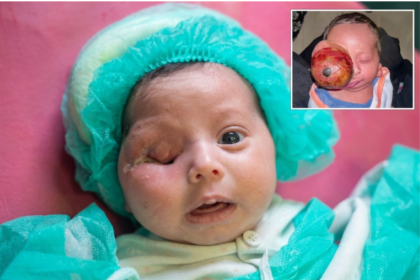 Pakistan reports first documented 285-gram congenital eye tumor in newborn