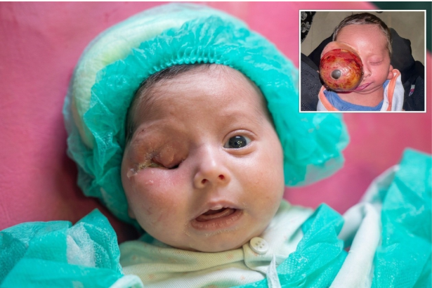 Pakistan reports first documented 285-gram congenital eye tumor in newborn Pakistan reports first documented 285-gram congenital eye tumor in newborn