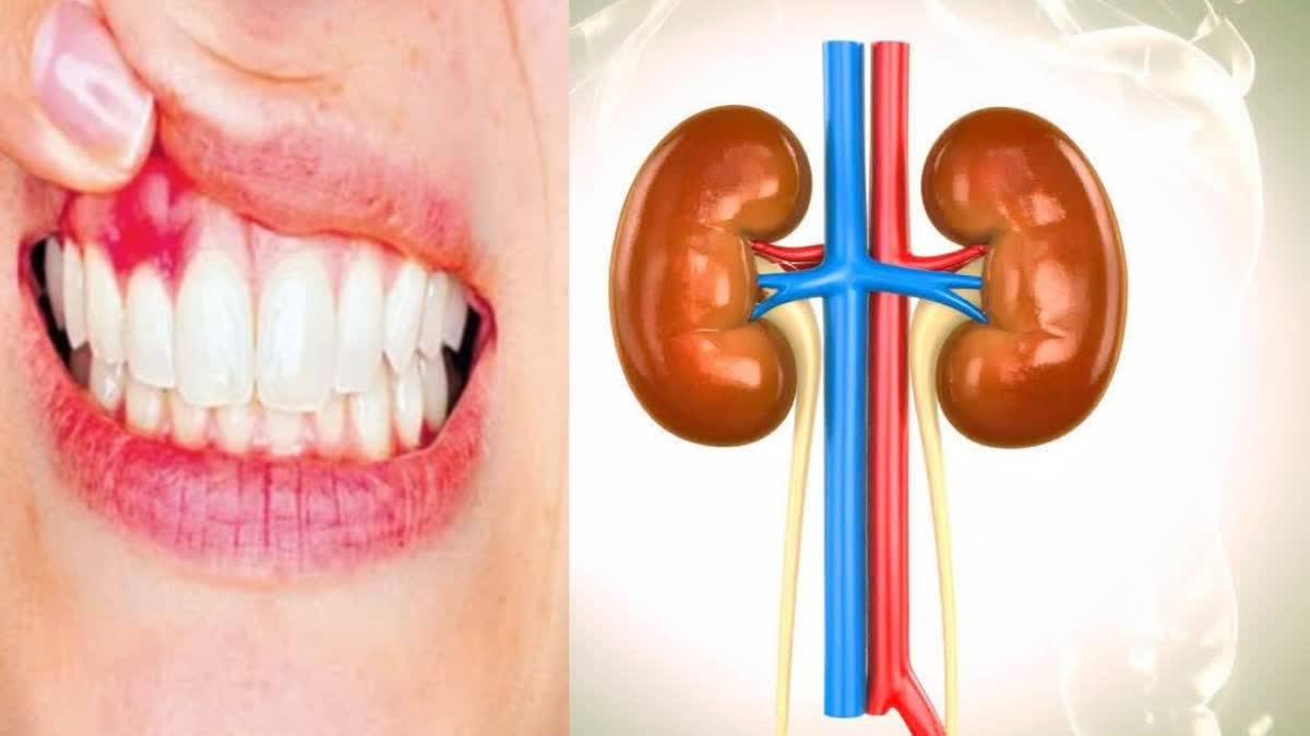 Severe Gum Disease May Be Linked to Early Kidney Damage, German Study Finds