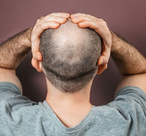 New hair loss research raises hope for regrowing lost hair