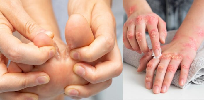 Fungal infection between the toes during the monsoon season,