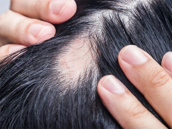 Study Suggests Possible Link Between Popular Weight-Loss Drugs and Hair Loss