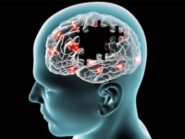 Experimental Alzheimer’s Drug Shows Early Promise In Reducing Brain Damage