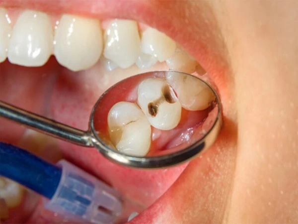 No Drill, No Injection: Simple Liquid May Stop Cavities in Young Children