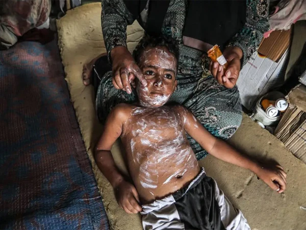 UN Warns of Rising Chickenpox Outbreak Among Displaced Children in Gaza