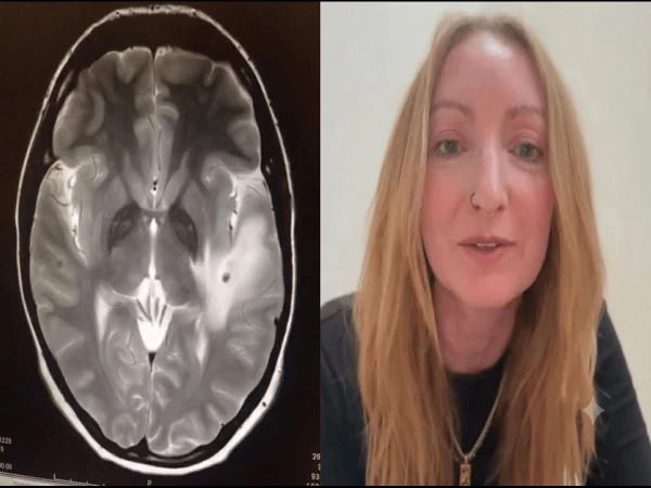 British woman develops rare brain infection after India trip, doctors find 38 parasites