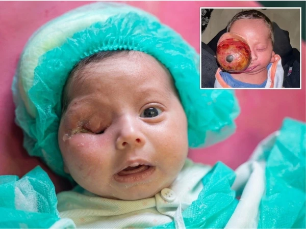 Surgeons Remove Rare 285-Gram Eye Tumor From Three-Day-Old Newborn