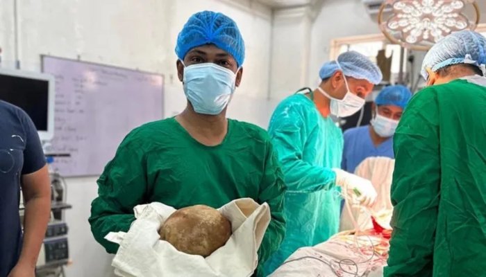Sri Lankan Doctors Remove 3.1kg Bladder Stone in Rare Medical Case