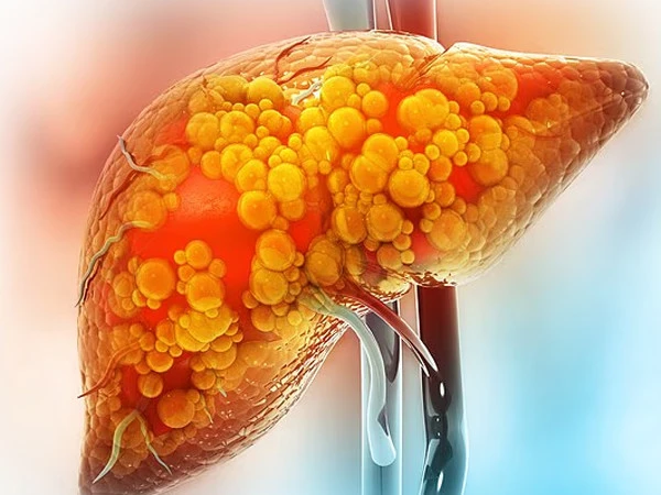 Liver Disease Can Remain Silent Until 80% of the Organ Is Damaged, Experts Warn