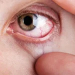 Experimental remigromig drug trial for diabetic eye disease
