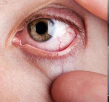 New Drug Shows Promise in Eye Disease Trial Experimental remigromig drug trial for diabetic eye disease