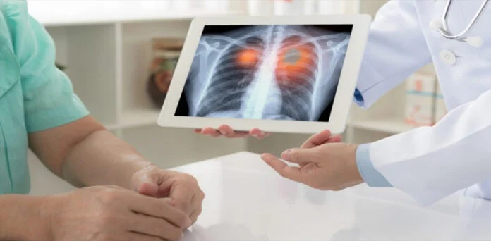 Experimental Lung Cancer Drug Gotistobart