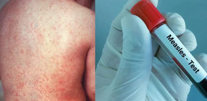 Bill Gates Says Measles Eradication Is Currently Out of Reach Amid Vaccine Hesitancy