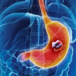 Early warning signs and symptoms of stomach cancer