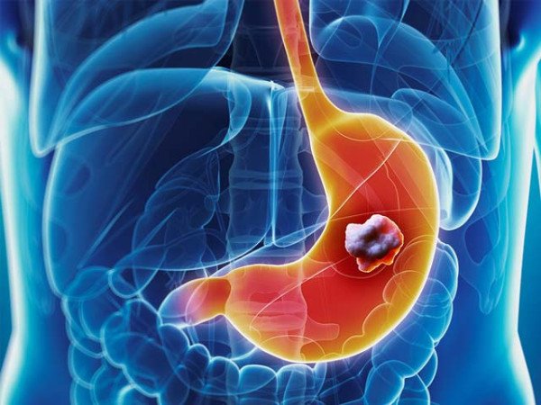 Stomach Cancer Silent Warning Signs Early warning signs and symptoms of stomach cancer