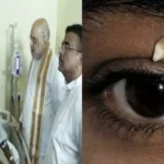 Rare Medical Case: Tooth Found in Teenager’s Eye Socket