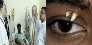 Rare Medical Case: Tooth Found in Teenager’s Eye Socket