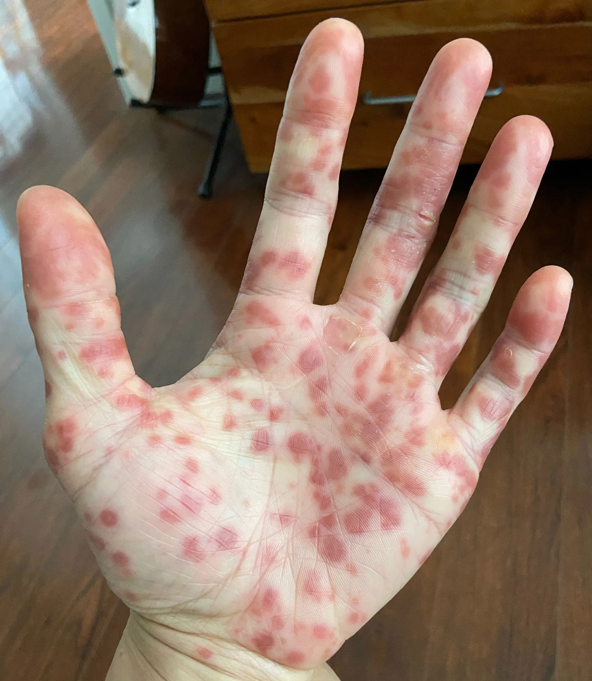 Another Suspected Mpox Case Reported in Sindh