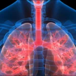 : Experimental admilparant drug shows promise in a clinical trial for pulmonary fibrosis.