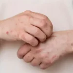 Two new Mpox cases reported in Karachi as Sindh total reaches 96.