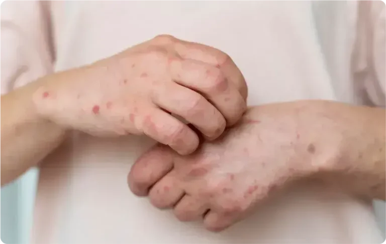 Two new Mpox cases reported in Karachi as Sindh total reaches 96.