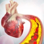 Childhood poverty linked to higher coronary artery disease risk