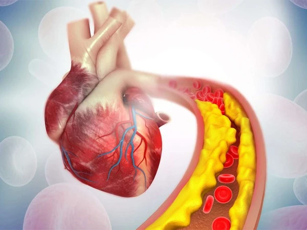 Childhood poverty linked to higher coronary artery disease risk