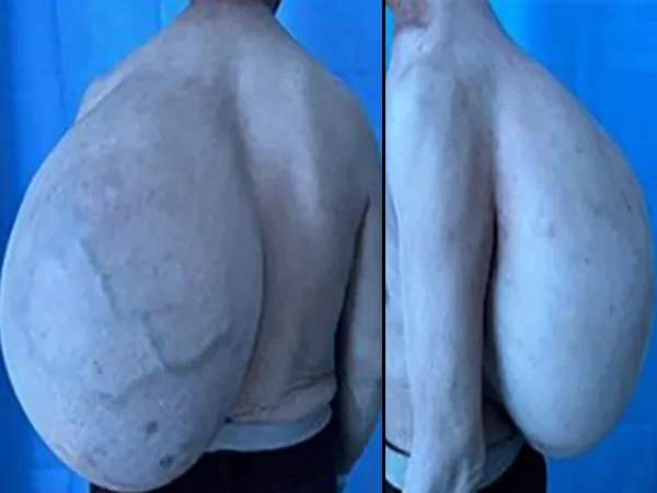 10-Kilogram Growth Removed in One Piece