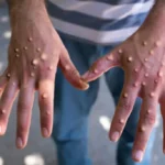 A Karachi hospital was sealed after an infant contracted mpox reportedly through contaminated circumcision equipment.
