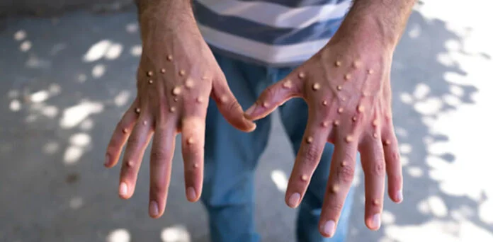 Karachi Hospital Sealed After Infant Contracts Mpox A Karachi hospital was sealed after an infant contracted mpox reportedly through contaminated circumcision equipment.